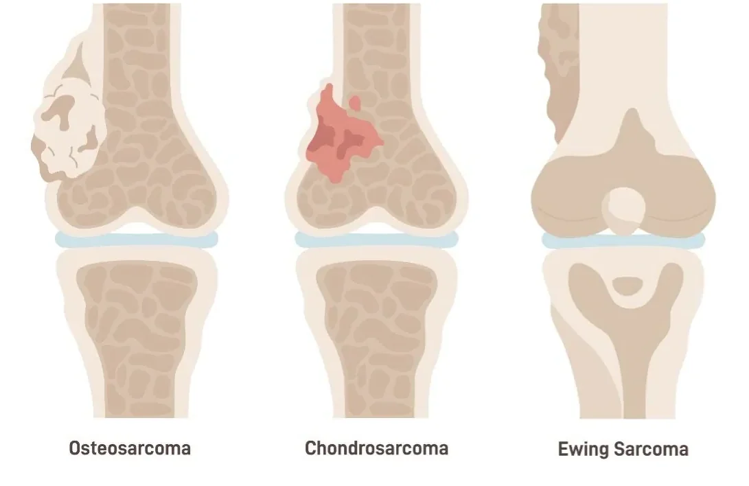 Illustration of the knee bones showing where osteosarcoma, chondrosarcoma and Ewing sarcoma typically grow
