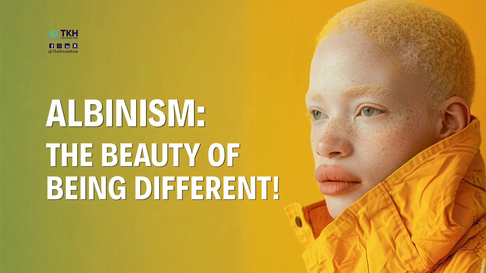 Albinism: The beauty of being different!
