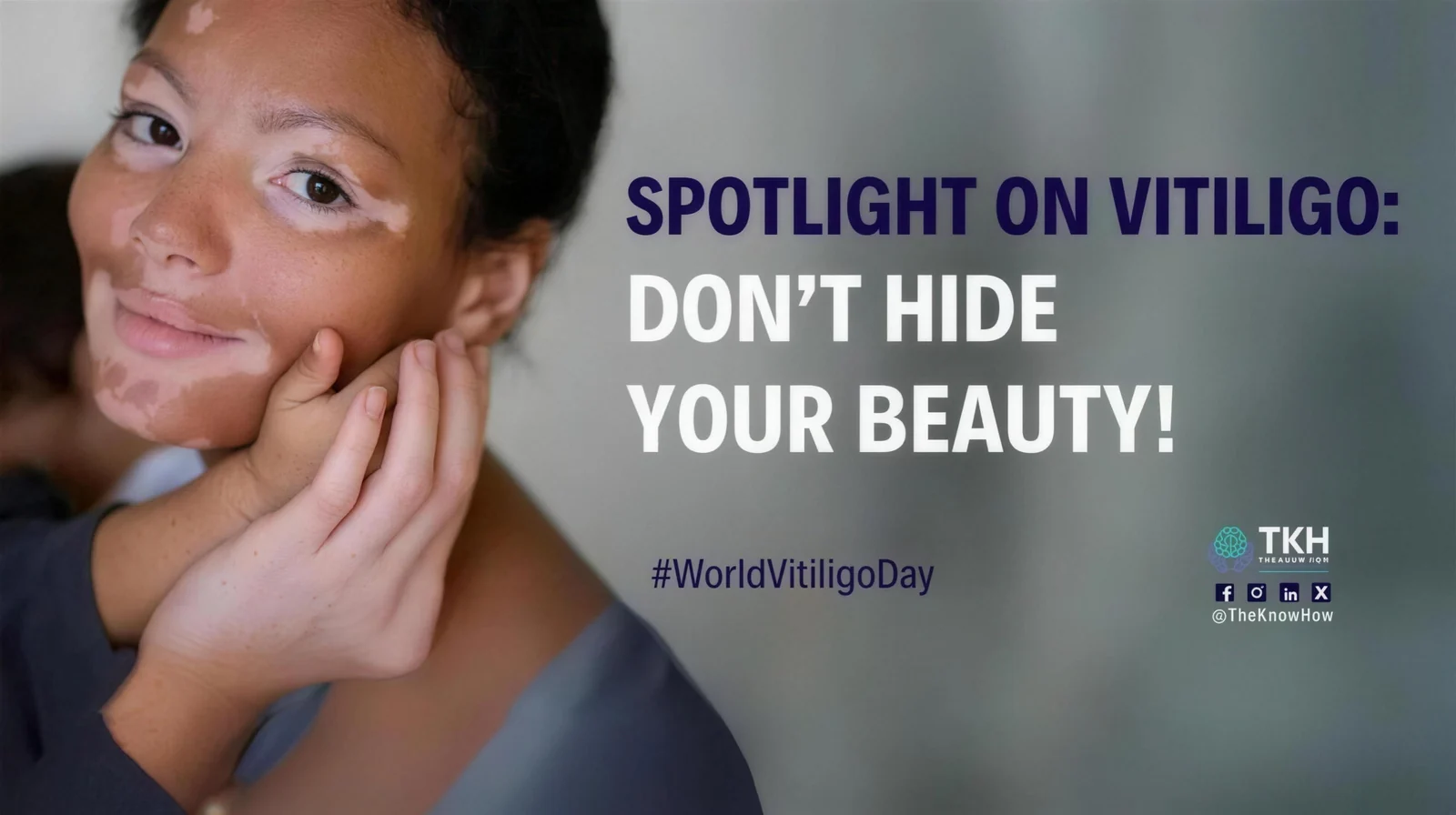 Spotlight on vitiligo: Don't hide your beauty!